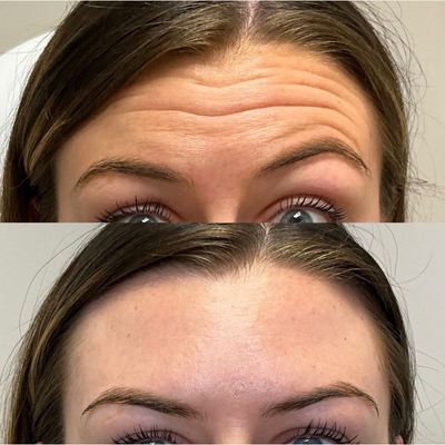 25-34 year old woman treated with Botox, Jeuveau, Dysport, Daxxify - Patient received a neurotoxin treatment to treat her glabella lines and forehead lines.