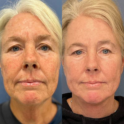 45-54 year old woman treated with BroadBand Light (BBL), NeoGen Plasma - This patient is about 4 weeks post neck lift. She received a Sciton BBL treatment and Neogen Plasma treatment immediately following the BBL to lift pigment and even her skin tone post surgery.