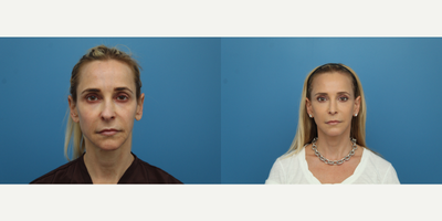 45-54 year old woman treated with Facial Fat Transfer - This patient came in wanting a fresher look. Dr. Balikian performed procedures for facial rejuvenation including a Facelift, Rhinoplasty and Fat Transfer to treat all areas of facial aging. The patient is thrilled to look like herself, look refreshed and breathe better.