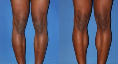 Calf Augmentation (Implants) - This 30 year old gentleman is one year after calf augmentation with medial soft, solid silicone implants placed in the subfascial position.&nbsp;