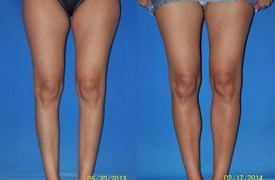 Calf Augmentation (Implants) - 36 year old woman 9 months after Calf Implants, medial and lateral performed by Dr. Sam Gershenbaum. She was looking to be very conservative and natural. A small lateral implant was added as well just to conservatively balance the shape.&nbsp;