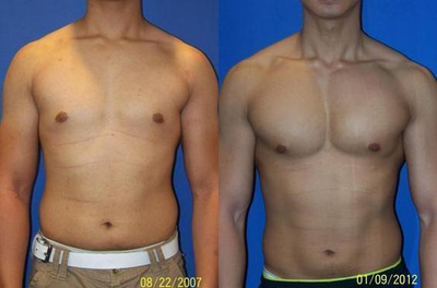 Male Pectoral Implants - 27 year old male 5 years after pec implants and liposculpture of his chest and waist was performed by Dr. Sam Gershenbaum. Vertical-rectangular soft, solid silicone implants were placed under the muscle.&nbsp;