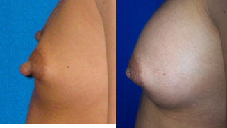 Nipple Reduction Surgery - The patient shown here was interested in nipple reduction surgery. The patient was unhappy with her nipples andcalled them protruding. The patient is now 1-month post-op surgery.