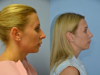 Rhinoplasty - 34 year old female 3 months after undergoing closed reduction rhinoplasty. We refined her tip, decreased her tip projection, decreased her dorsal hump, infractered her and rotated her tip upward somewhat.