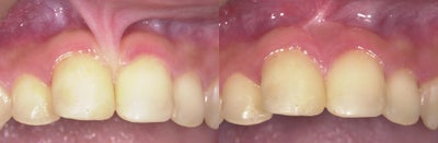 15 year old female treated for frenum pull. - Patient had very high frenum and was unable to maintain proper oral hygiene in the area. Frenectomy was performed and a free gingival graft was place to cover area where frenum was released.