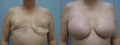 Breast Reconstruction - 47yo with previous Bilateral Mastectomy has Latissimus Dorsi Flap Reconstruction with 500cc gel implants&nbsp;