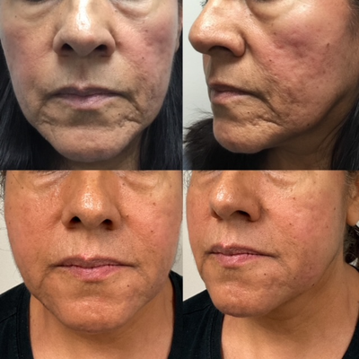 55-64 year old woman treated with Radiesse, Microneedling - ID 221860This lovely woman aimed to address her deep acne scarring. She underwent three sessions of micro needling, along with acne scar subcision. Once healed, she received a Radiesse 1.5cc treatment, which provided an even smoother result. Treatment provided by Christina NP-C