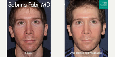 35-44 year old man treated with Vbeam - Vbeam used to treat redness and Radiesse adds facial volume to a male patient.