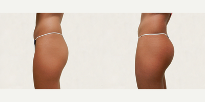 Woman treated with Brazilian Butt Lift - Woman treated with Brazilian Butt Lift