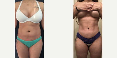 35-44 year old woman treated with Liposuction - Beautiful post op results in this 37 year old patient from Texas two months after 360 liposuction and Brazilian butt lift with Premium Care. Surgical time was minimized using two plastic surgeons, and she spent 10 days after surgery recovering in Cartagena at our five star Recovery Suites. Her figure looks amazing!