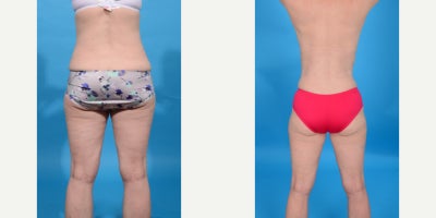 45-54 year old woman treated with Abdominal Etching, Diastasis Recti Repair, Drainless Tummy Tuck, Liposculpture, Liposuction, M - Tummy Tuck/abdominoplasty revision. This patient had a tummy tuck by another surgeon and was unhappy with her result. I did a Tummy Tuck Revision. I removed and lowered her previous tummy tuck incision to make it lower and covered with a bikini (bikini incision). I did aggressive VASER ultrasound liposuction of her abdomen and waist (Lipo 360) to give her a flatter abdomen and more hourglass shape. I retightened her abdominal muscles using a 3 vector corset plication technique which flattens the abdomen and gives a more hourglass shape. I then removed all excess lower abdominal skin.
