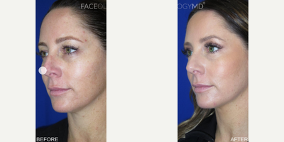 Woman treated with Eyelid Surgery, CO2 Laser, Profound RF - Woman treated with Eyelid Surgery, CO2 Laser, Profound RF
