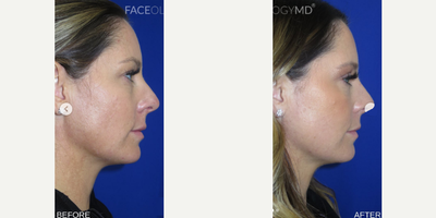 Woman treated with Eyelid Surgery, CO2 Laser, Profound RF - Woman treated with Eyelid Surgery, CO2 Laser, Profound RF