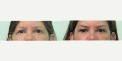 55-64 year old woman treated with Brow Lift - This middle-aged woman presented with a history of previous upper blepharoplasty who did not like the appearance of droopiness at the outer corners of her eyes. She had tried botox a few times, but was not able to get sufficient lift from the botox.We decided together to perform a lateral browlift under local anesthesia in the office. Well placed incisions in the hairline were made in order to remove skin and lift the corners of the brow. Total procedure time was under one hour and sutures were removed in one week.Her results demonstrate moderate opening of the outer corners of her eyes with a natural overall improvement.