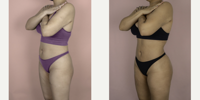 18-24 year old woman treated with Brazilian Butt Lift Revision - This patient had two prior BBL procedures by another surgeon and was unhappy with her results. She is shown here 6 months after surgery with me and is very happy with her improved volume, projection and natural result.