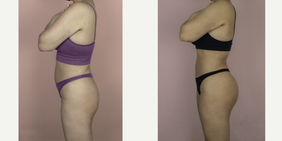 18-24 year old woman treated with Brazilian Butt Lift Revision - This patient had two prior BBL procedures by another surgeon and was unhappy with her results. She is shown here 6 months after surgery with me and is very happy with her improved volume, projection and natural result.