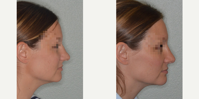 25-34 year old woman treated with Rhinoplasty - Patient with a severely crooked nose. Primary rhinoplasty techniques included an open rhinoplasty approach, right-sided osteotomy, bilateral spreader grafts, clocking suture, footplate suture, temporalis fascia onlay grafts, caudal septal extension graft, and tip onlay graft.