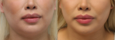 25-34 year old woman treated with Jaw Reduction - Mandible Contouring