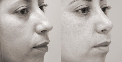 Rhinoplasty - Rhino
