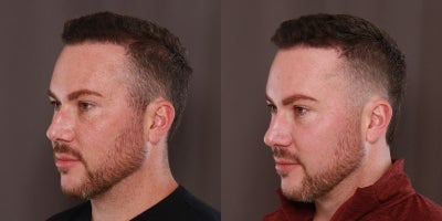 18-24 year old man treated with Moxi - 1 Moxi and Sylfirm Treatment