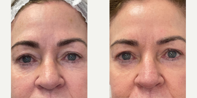 65-74 year old woman treated with Halo Laser, ProFractional Laser - HALO and ProFractional laser treatments performed at 8 West Clinic, Vancouver, BC