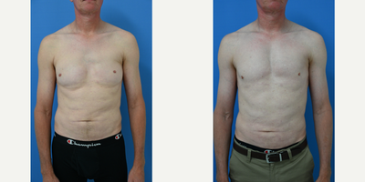 45-54 year old man treated with Pec Implants - 47 year old male from Iowa 7 months after exchange and repair of pectoral implants performed by Dr Sam Gershenbaum. Patient has a history of left side Polands Syndrome(partial absence of pectoral muscle) with an attempt to improve the appearance of his chest with pectoral implants. The surgeon he went to, however, was not well versed in pectoral implant surgery. The implants were placed in a subglandular/subcutaneous location and ended up too low, and only making things look worse. I removed his old malpositioned implants and placed new conservative sized soft solid silicone vertical rectangular in the correct location under his muscle. Although he still has some deficiency on his left side from the absence of his full muscle, he still has a full athletic normal chest shape. The patient is very happy with his results.