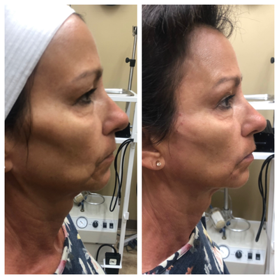 45-54 year old woman treated with Dermal Fillers - Fillers below the check bone to fill out patients face after weight loss.