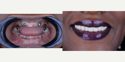55-64 year old woman treated with All-on-4 Dental Implants - Patient, we did 6 top dental implants an 4 Bottom dental implants, Porcelain Overdenture and she is ready to smile again.