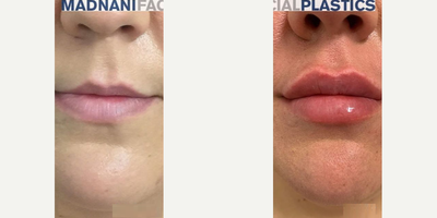 Woman treated with Volbella - Woman treated with 1 syringe of Volbella to increase lip volume and bring more symmetry to the lips.