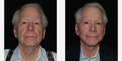 65-74 year old man treated with Facelift - Face and Neck Lift with Fat Transfer, Upper Blepharoplasty and Endoscopic Brow Lift