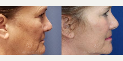 Woman treated with Eyelid Surgery - Woman treated with Eyelid Surgery