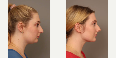 Woman treated with Smart Lipo - Woman treated with Chin Liposuction through Smart Lipo. Pre-op, patient had fullness behind her chin since childhood, regardless of her weight.