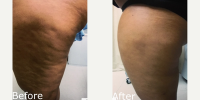 Woman treated with Cellulaze - Woman treated with Cellulaze