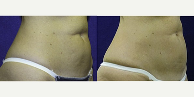 35-44 year old woman treated with Liposonix - 35-44 year old woman treated with Liposonix
