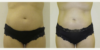 35-44 year old woman treated with Liposonix - 35-44 year old woman treated with Liposonix