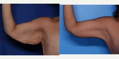 35-44 year old woman treated with Arm Lift - 37 year old female shown 2 years after an arm lift. She had lost 180 pounds with weight loss surgery.