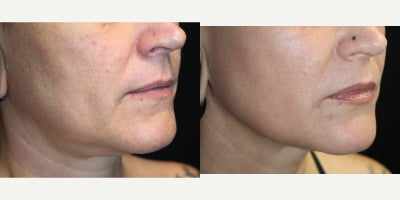 45-54 year old woman treated with UltraClear Laser - 45-54 year old woman treated with UltraClear Laser for the face and neck.