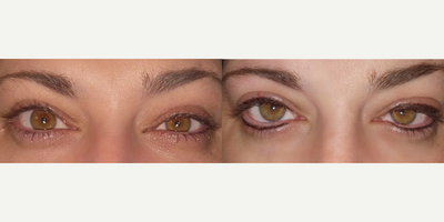 35-44 year old woman treated with Permanent Makeup - Permanent Eyeliner Before and After pictures by Dr. Deborah Sillins of Rejuvene Plastic Surgery in Northern Kentucky and Cincinnati.