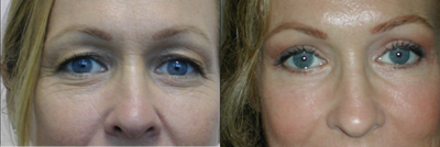 35-44 year old woman treated with Eyelid Surgery - upper and lower transcutaneous blepharoplasty