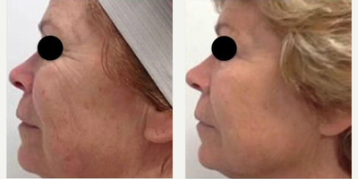 Woman treated with Infini RF - Woman treated with Infini RF
