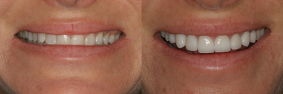 Smile Makeover with Minimal-Prep and No-Prep Veneers - This 35 year-old patient wanted a bigger whiter smile.&nbsp; I&nbsp;used no-prep and minimal-prep UltraVeneers to transform her smile.&nbsp; She is incredibly pleased with her new smile.