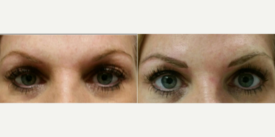 35-44 year old woman treated with Permanent Makeup - Patient had a full eyebrow tattoo using the new microstroking technique.