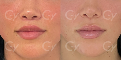 25-34 year old woman treated with Lip Lift, Lip Fillers, Lip Surgery - 25-34 year old woman treated with Lip Lift, Lip Fillers, Lip Surgery by M.D. Gray Yeiladal