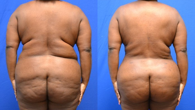 45 Year Old Female, Brazilian Butt Lift - 45 year old female who underwent Brazilian Butt Lift (BBL) with Liposuction of upper and lower abdomen, waistline, bra rolls and axilla.
A total of  1080 cc of fat was injected into the left buttock. A total of 1020 cc of fat was injected into the right.  Post op 3 months.