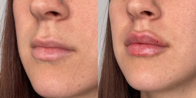 25-34 year old woman treated with Lip Fillers - patient treated with 1 syringe of RHA2 for lip augmentation