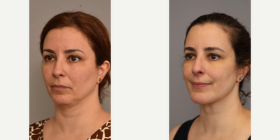 Woman treated with Neck Lift - Woman treated with Neck Lift and Chin Implant. Pre-op, patient came in wanting a nicely defined jawline and to clean up her neck to achieve a more youthful look.