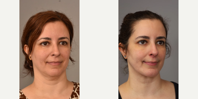 Woman treated with Neck Lift - Woman treated with Neck Lift and Chin Implant. Pre-op, patient came in wanting a nicely defined jawline and to clean up her neck to achieve a more youthful look.