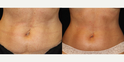 55-64 year old woman treated with Belly Button Surgery - This patient did not like the way her belly button looked after surgery. Dr. Anton repaired her umbilical hernia and reattached her belly button 1 cm to the left to make it look straighter.