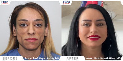 35-44 year old woman treated with Facial Fat Transfer - Woman treated with Facial fat transfer. 3 sessions were applied, within intervals between them.