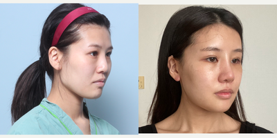 25-34 year old woman treated with Cheekbone Reduction, Jaw Reduction, Asian Rhinoplasty, Facial Fat Transfer - Facial Contouring 3 combination (ZAC: Zygoma reduction, angular jawline, chin)Revision Open- RhinoplastyEpicanthoplastyLower HotzLateral CanthoplastyFacial fat grafting